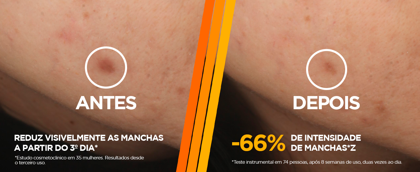 Pele antes e depois do uso do Sérum Antimarcas Garnier Uniform e Matte, com resultados comprovados