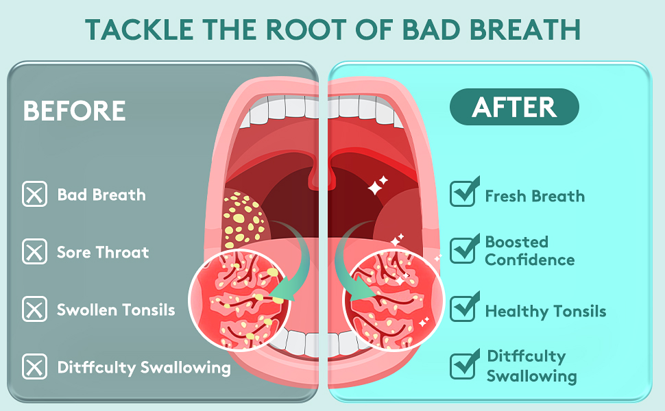 Electronic Vacuum Tonsil Stone Remover Tonsil Stone Removal Kit with Builtin LED Light & 3