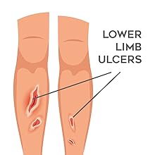 burn kit silicone adhesive foam dressing wound care products gauze wound dressing sterile