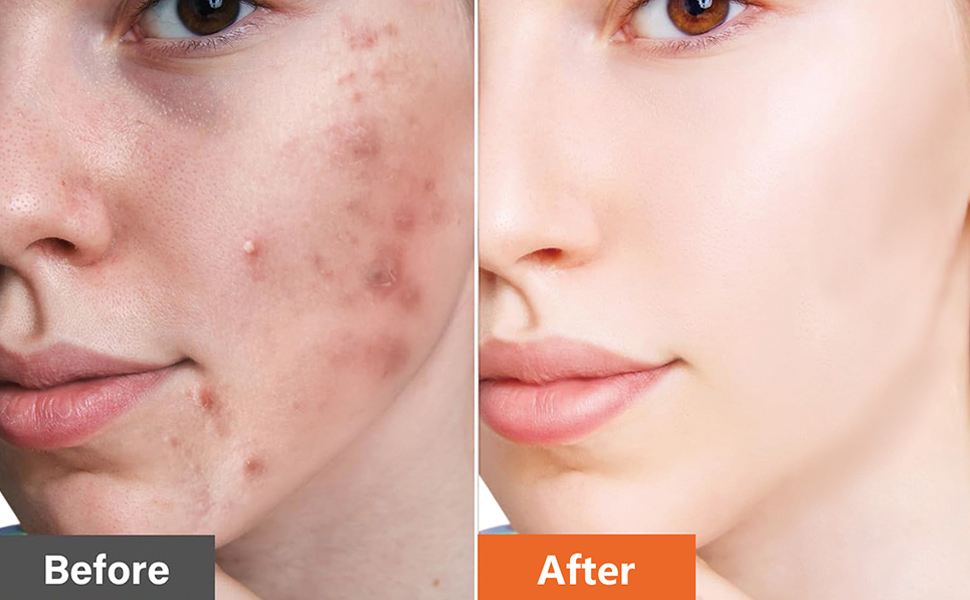 Azelaic Acid Acne Cream With Aloe Extract