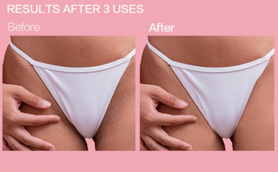 razor bump treatment razor bump treatment for bikini area ingrown hair serum