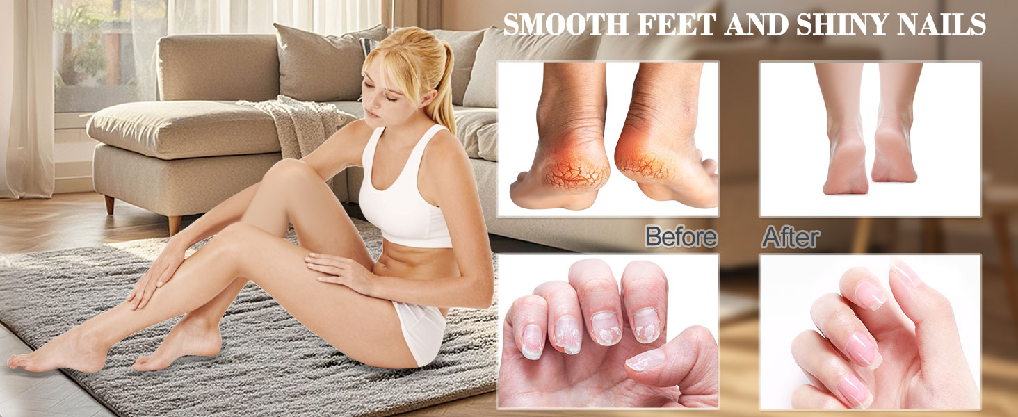 electric callus remover