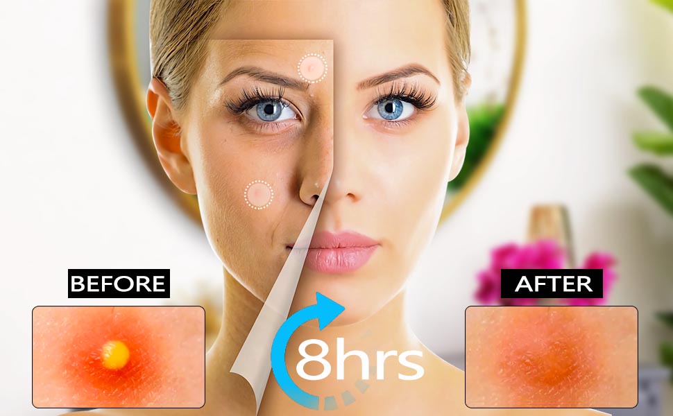 pimple patches invisible