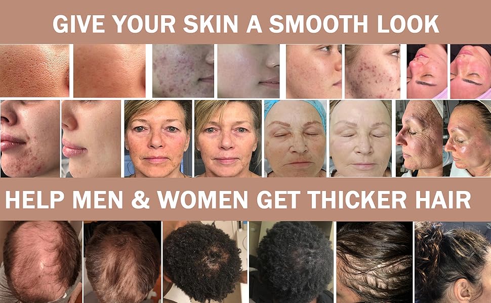 derma roller hair growth