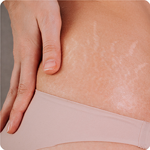 Dimunui Manchas e Estrias