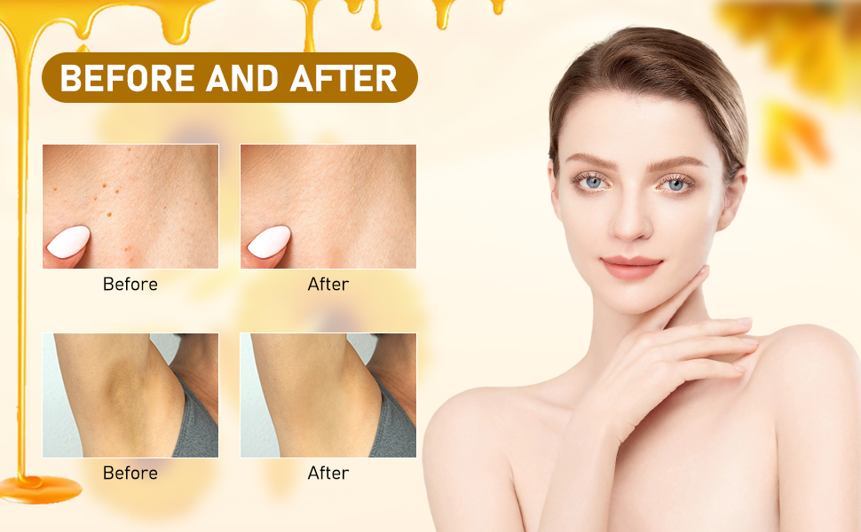 Bee Venom 𝐖𝐚𝐫𝐭 Cream, 𝐁𝐞𝐞 𝐕𝐞𝐧𝐨𝐦 𝐌𝐨𝐥𝐞, 𝐁𝐞𝐞 𝐕𝐞𝐧𝐨𝐦 Cream for Skin Tags - Does Bee Venom Work To Remove Skin Tags