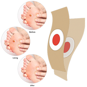 dornwarzen entfernen