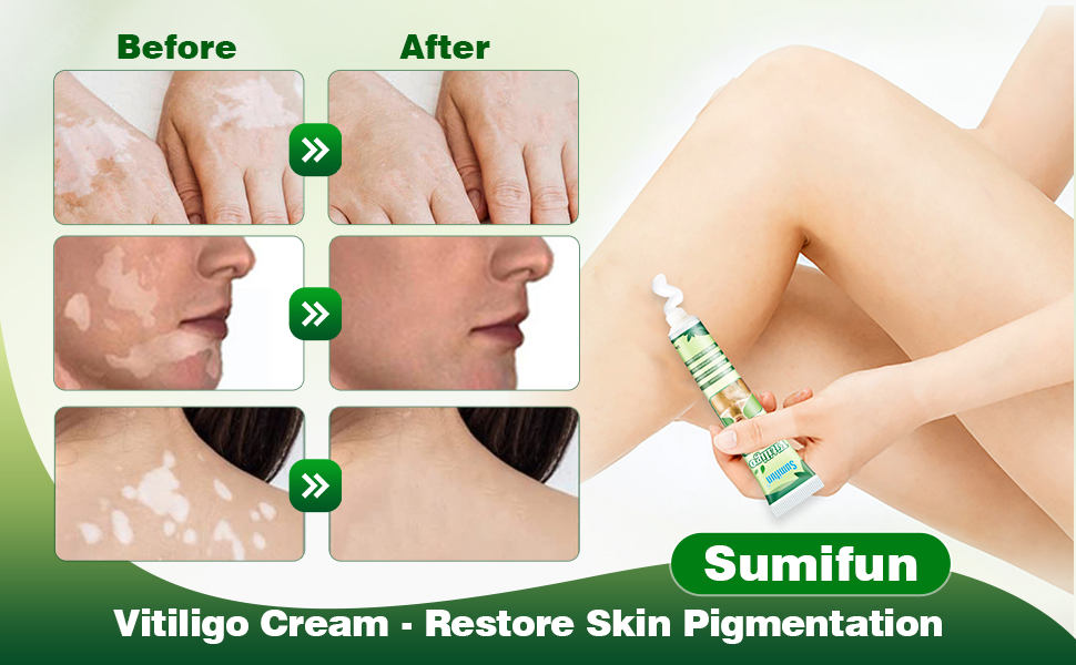 VITILIGO CARE CREAM