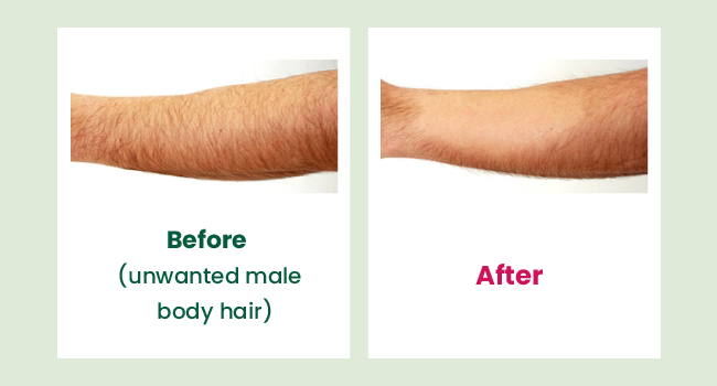 hair removal cream inhibitor