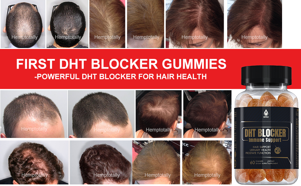 DHT Blocker Gummies-for hair health-men&women