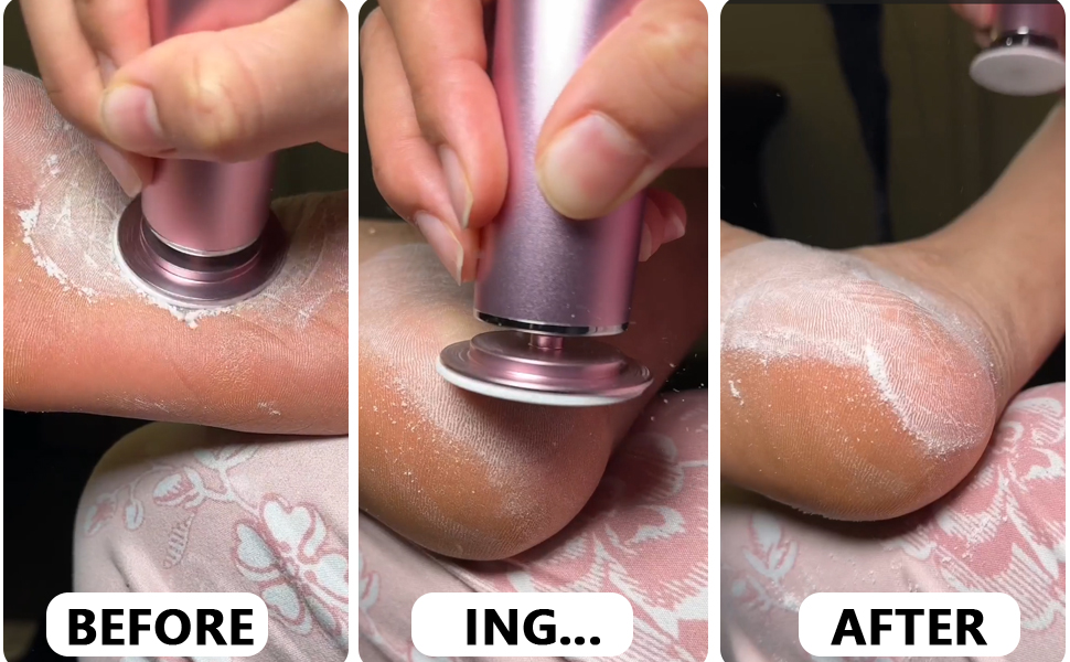 electric foot callus remover