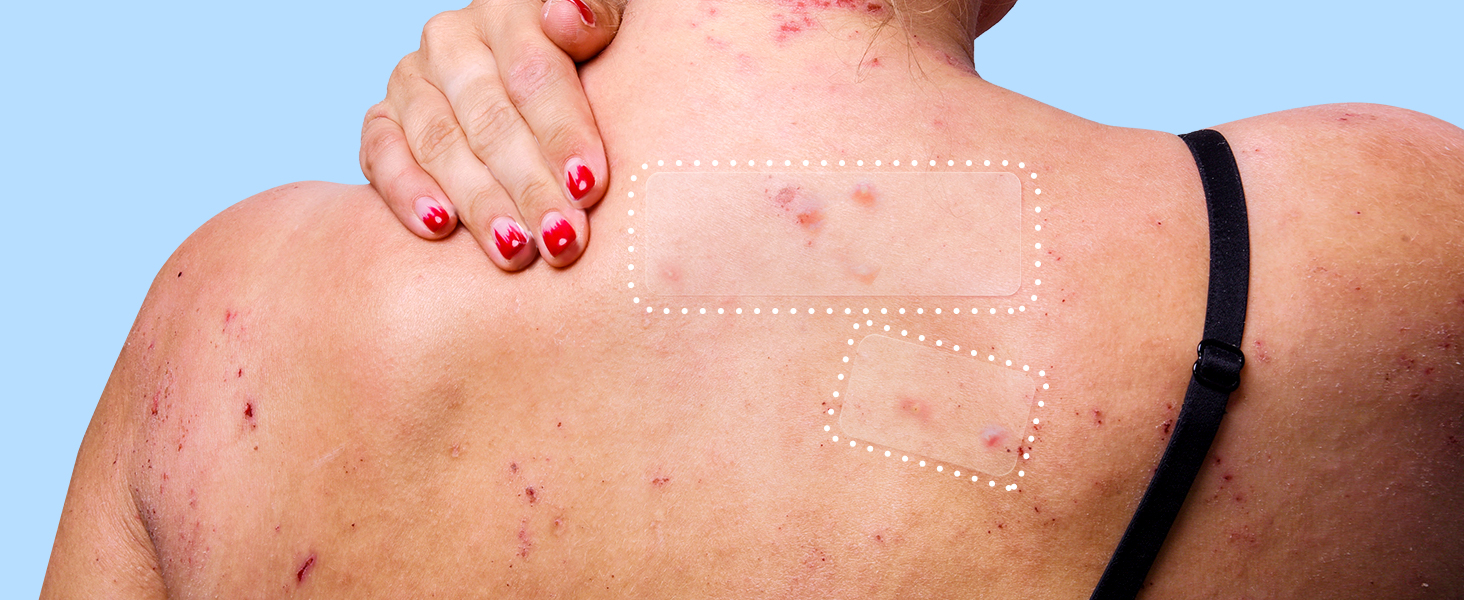 pimple patches