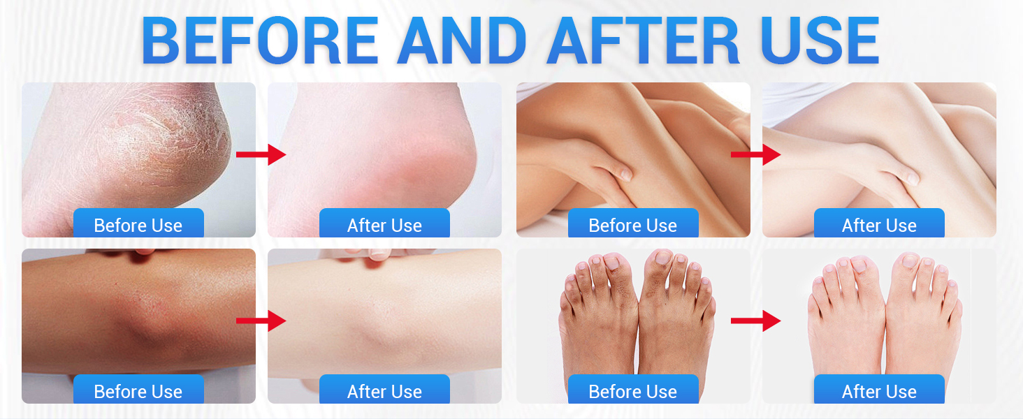 callus remover