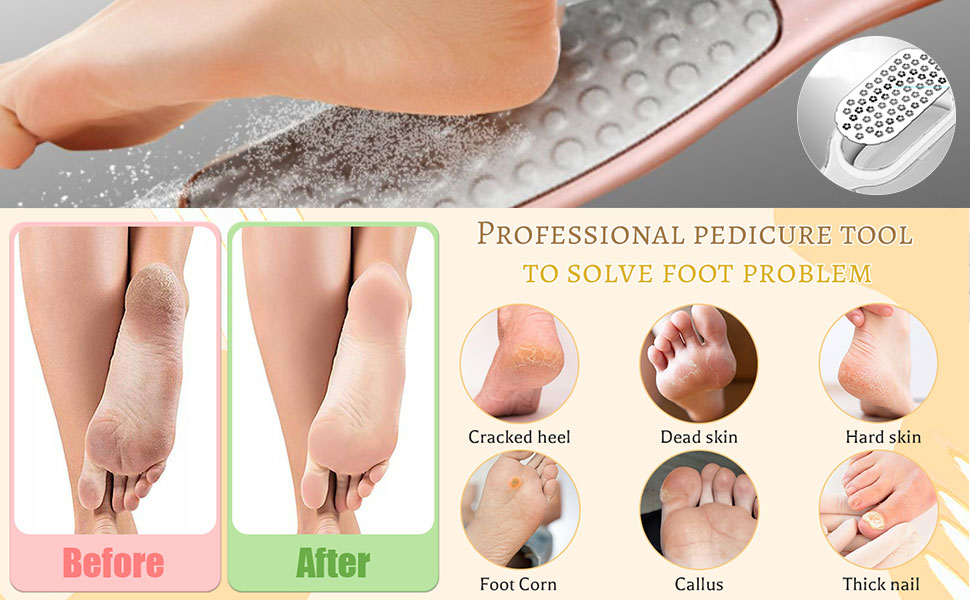 Foot Heel Craper for Cracked Heels