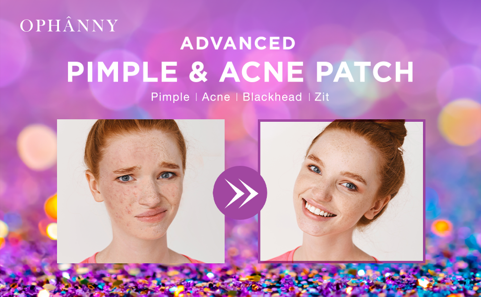 Pimple Patches Cute, Acne Patches For Face, Hydrocolloid