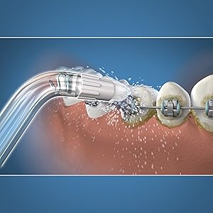 Using the Waterpik Orthodontic Tip OD-100E