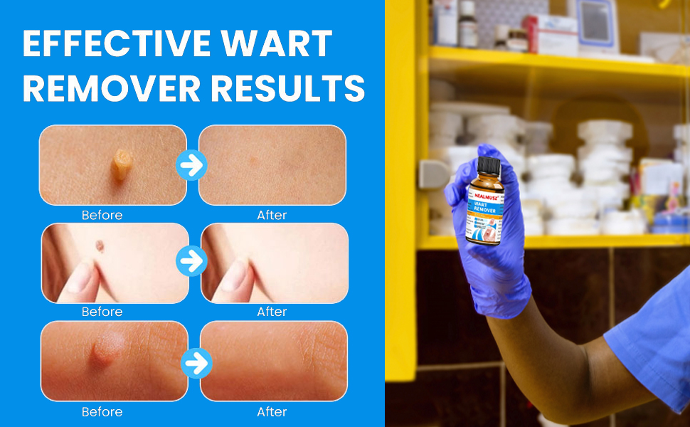 Wart Removal