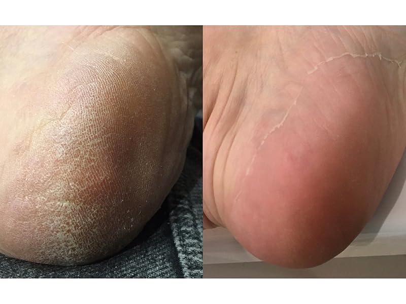 Before and after results from Plantifique customer after using the foot mask for dry cracked feet