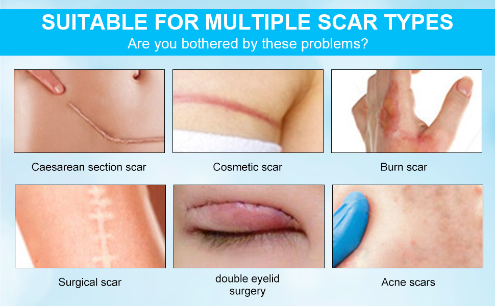 acne scar treatment