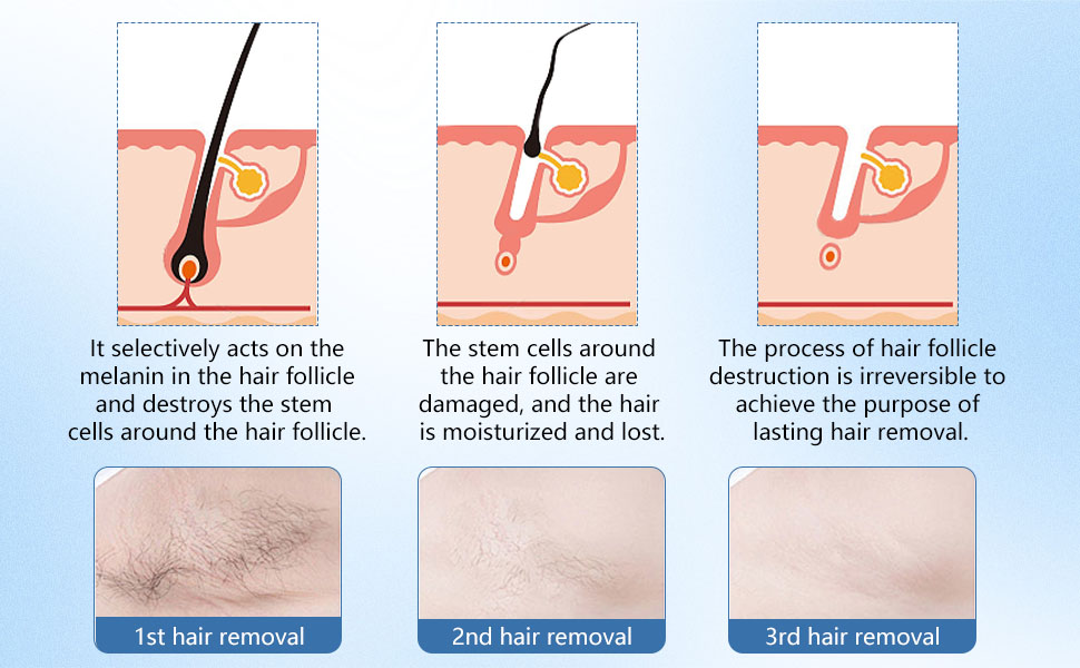 Technical illustration sequence showing step-by-step process with text labels '1st hair removal', '2nd hair removal', '3rd hair removal', depicting stages of a procedure.
