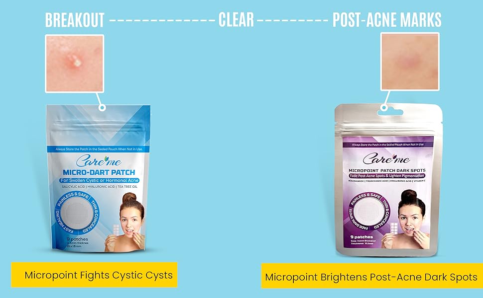 micropoint for cystic zits