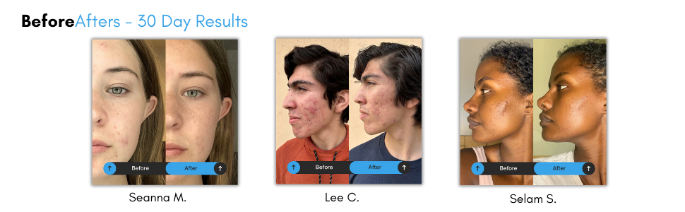 acne treatment for adults with acne kids acne acne cream for girls acne serum for boys