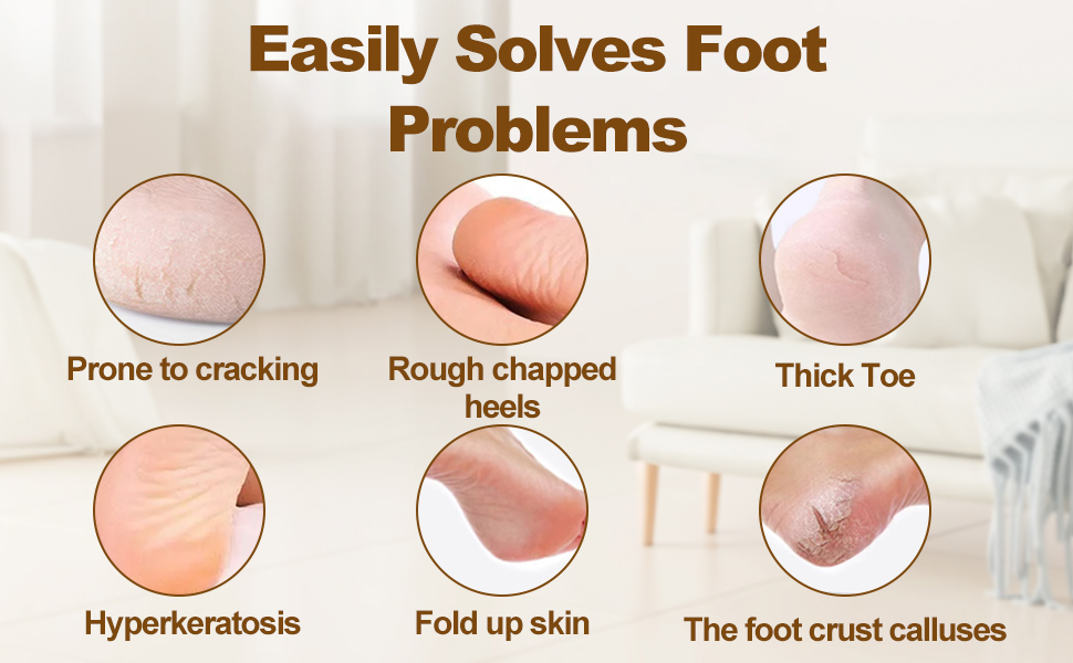 Foot File Callus Remover