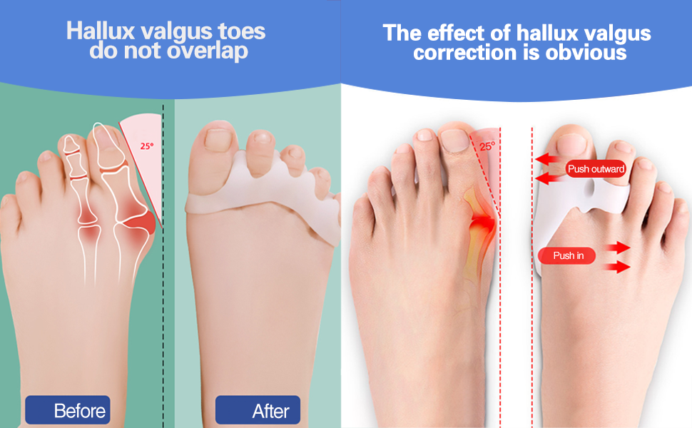 hallux valgus