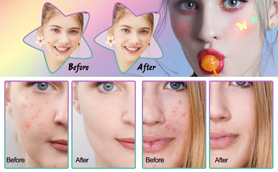 REBODUM Acne Patches, Starface Cute Laser Hydrocolloid Acne