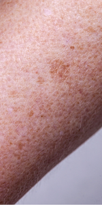 hyperpigmentation led face mask light therapy