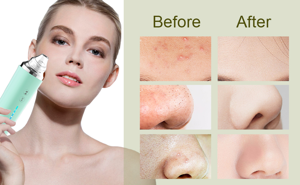 Blackhead Remover Pore Vacuum with Camera, [FDA Certification] Black