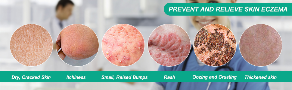 prevent and relieve skin eczema