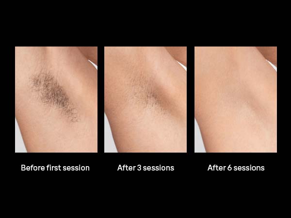 Braun Smart IPL, Skin i·Expert Pro 7