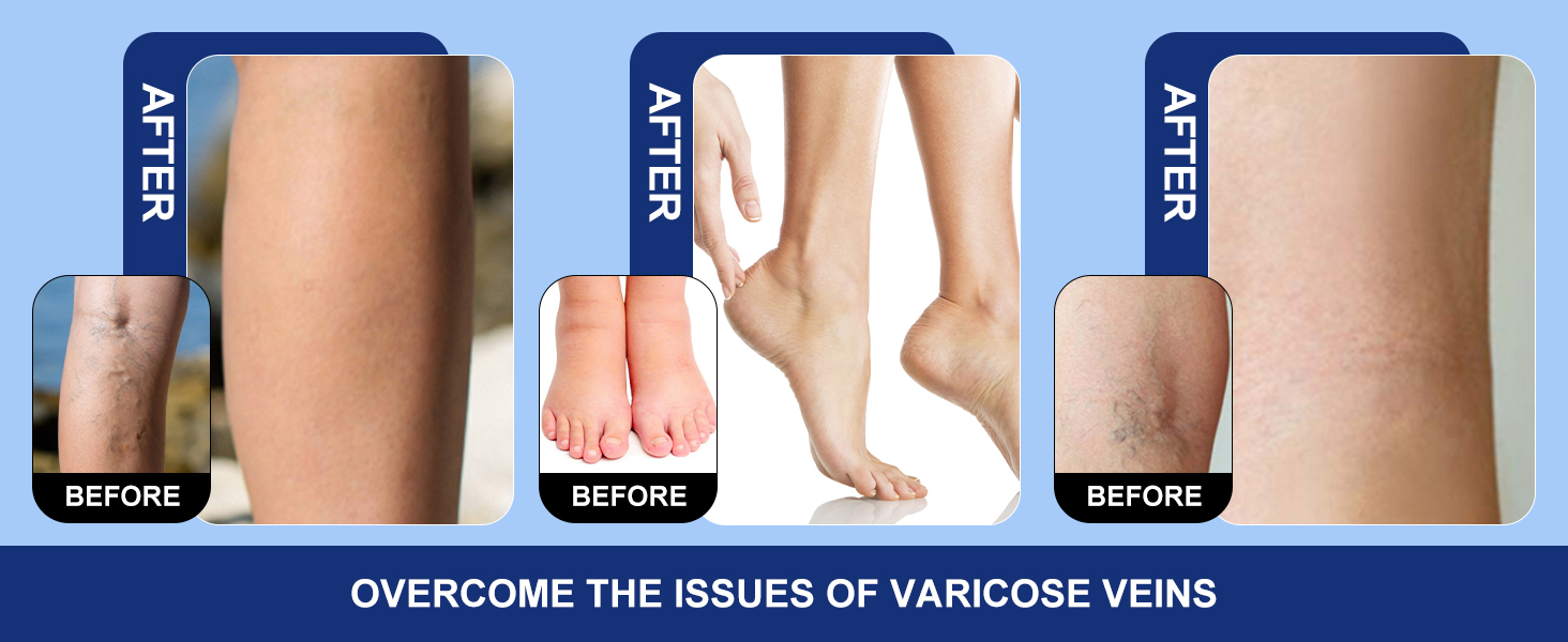 crema para varices