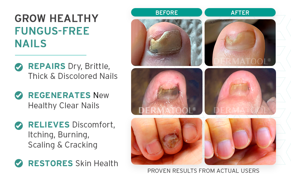 Toenail Fungus Treatment Extra Strength Antifungal