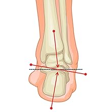 Improve over pronation