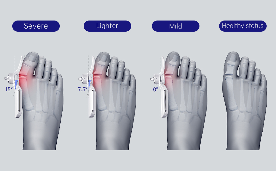 Bunion Corrector for men