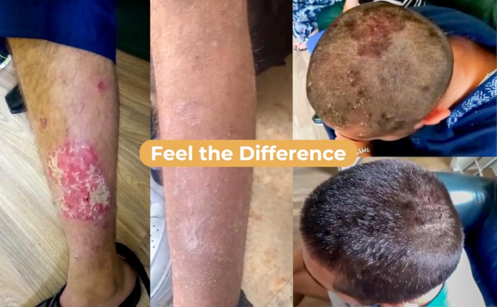 Psoriaskin Supplement before and after