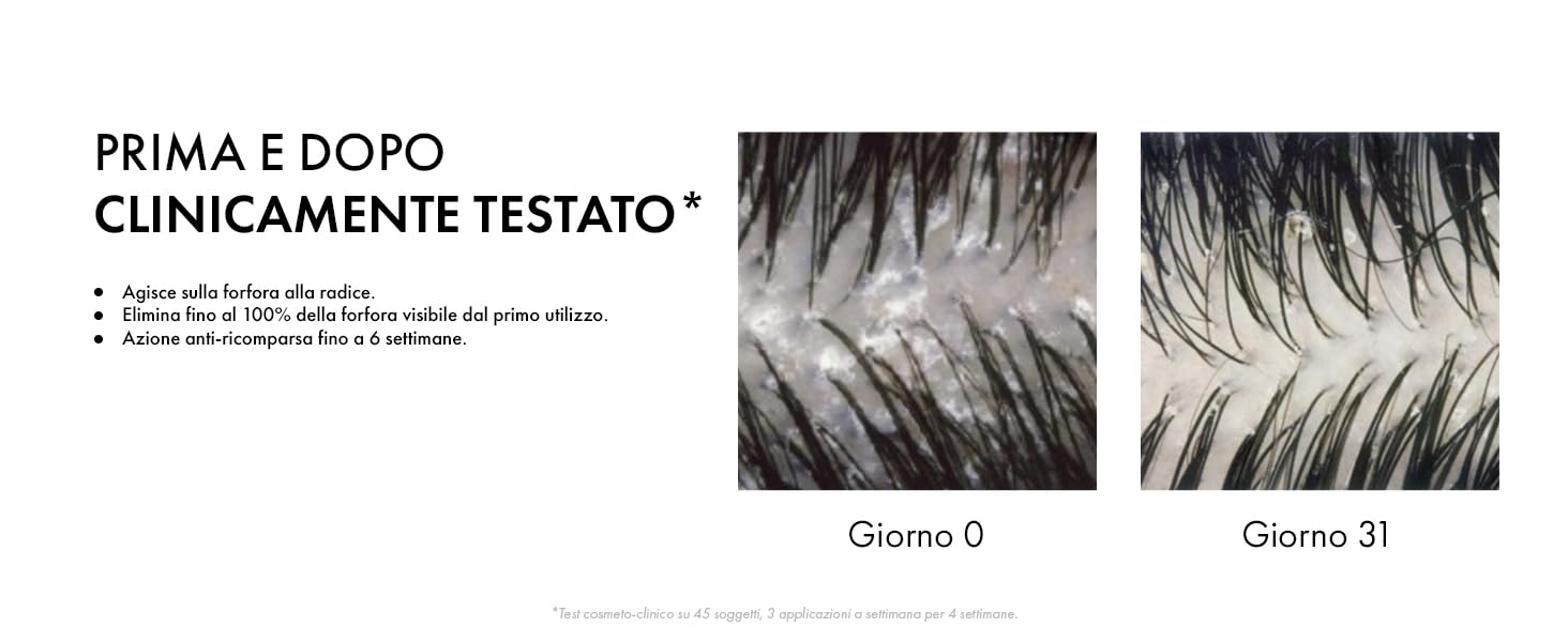 Clinicamente provato, elimina il 100% della forfora