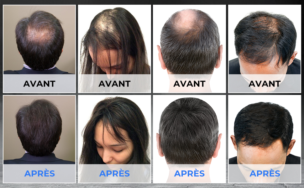 Comparaison avant et après des traitements de restauration capillaire. Quatre séries d'images montrent une augmentation de la densité capillaire et de la couverture des zones calviques du cuir chevelu après le traitement
