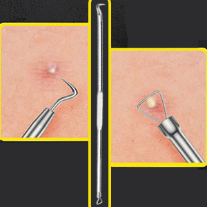 Mitesserentferner aus Edelstahl