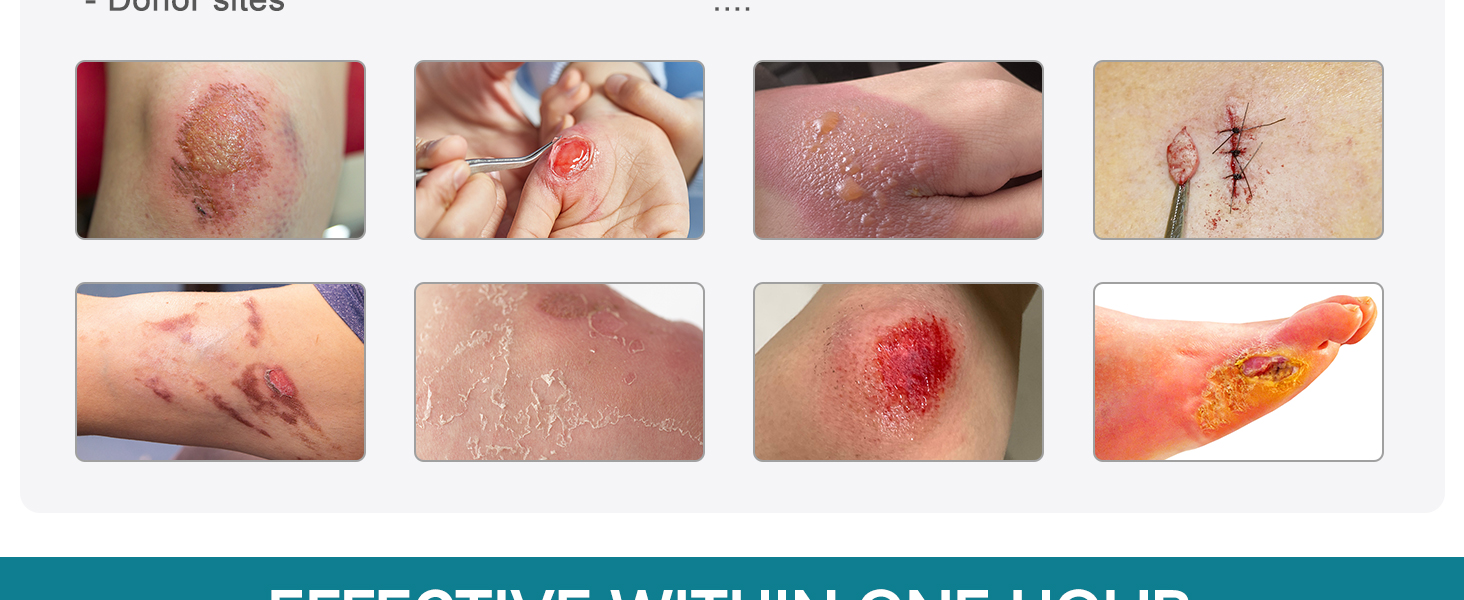 CEEPORT Medical Xeroform Petrolatum Dressing 5x9 Non-Adherent Gauze Pad Strip Gauze Patch Wound Care