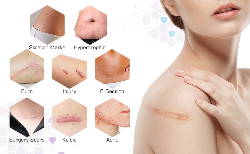 scars