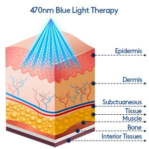 Blue light therapy