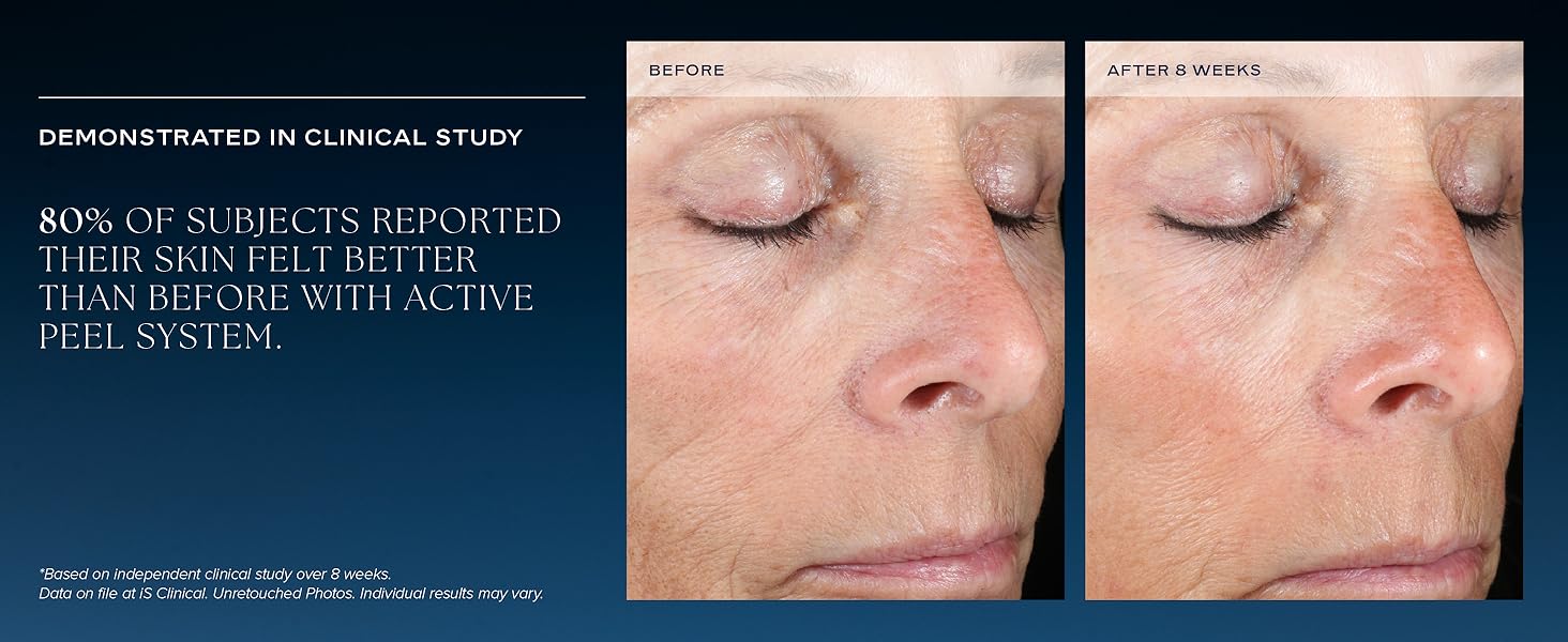 clinical study 80% subject reported skin felt better than before with active peel system
