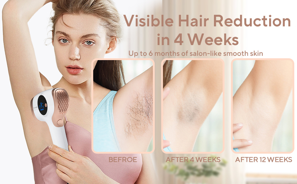 laser hair removal IPL laser hair removal
