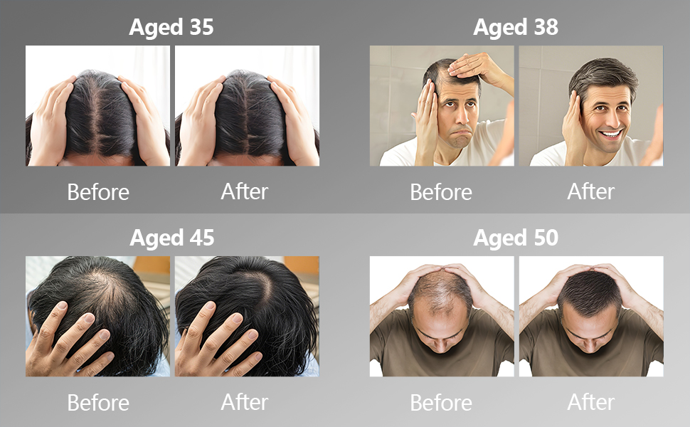 red light therapy for hair growth