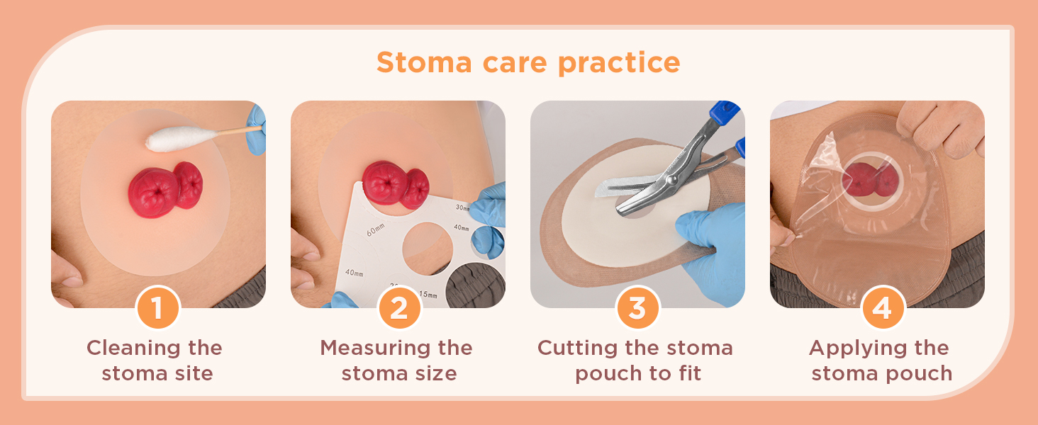 Stoma Training Model