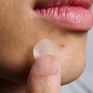 Male with acne patch on his finger tip holding up to pimple on chin.