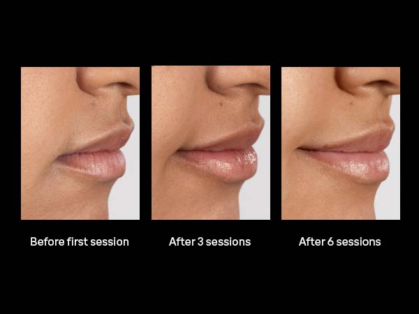 Braun Smart IPL, Skin i·Expert Pro 7